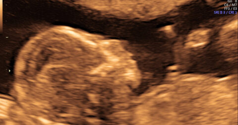 Abilene Christian University (ACU): Calling Abortion Murder is Hate Speech!